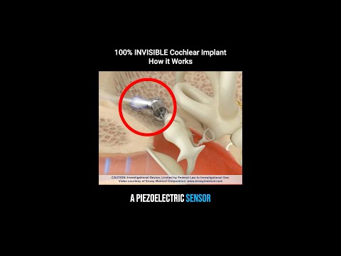 The New INVISIBLE Cochlear Implant